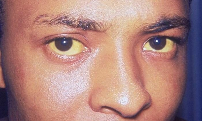 Jaundice_eye